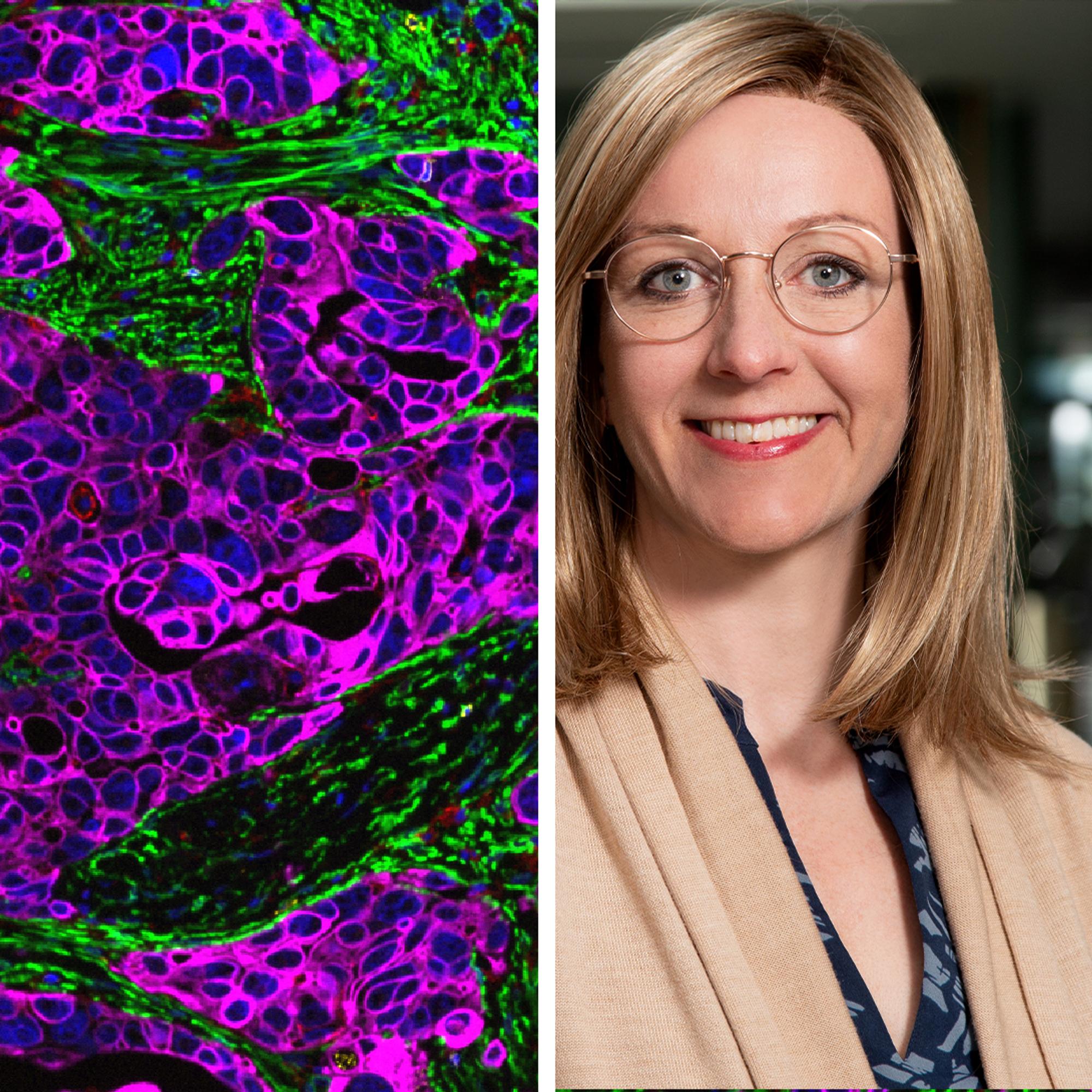 Suomalaiset tutkijat tekivät merkittävän löydön: syöpä piiloutuu ja muokkaa elimistön puolustusta – Tieto voi mullistaa munasarjasyövän hoidon