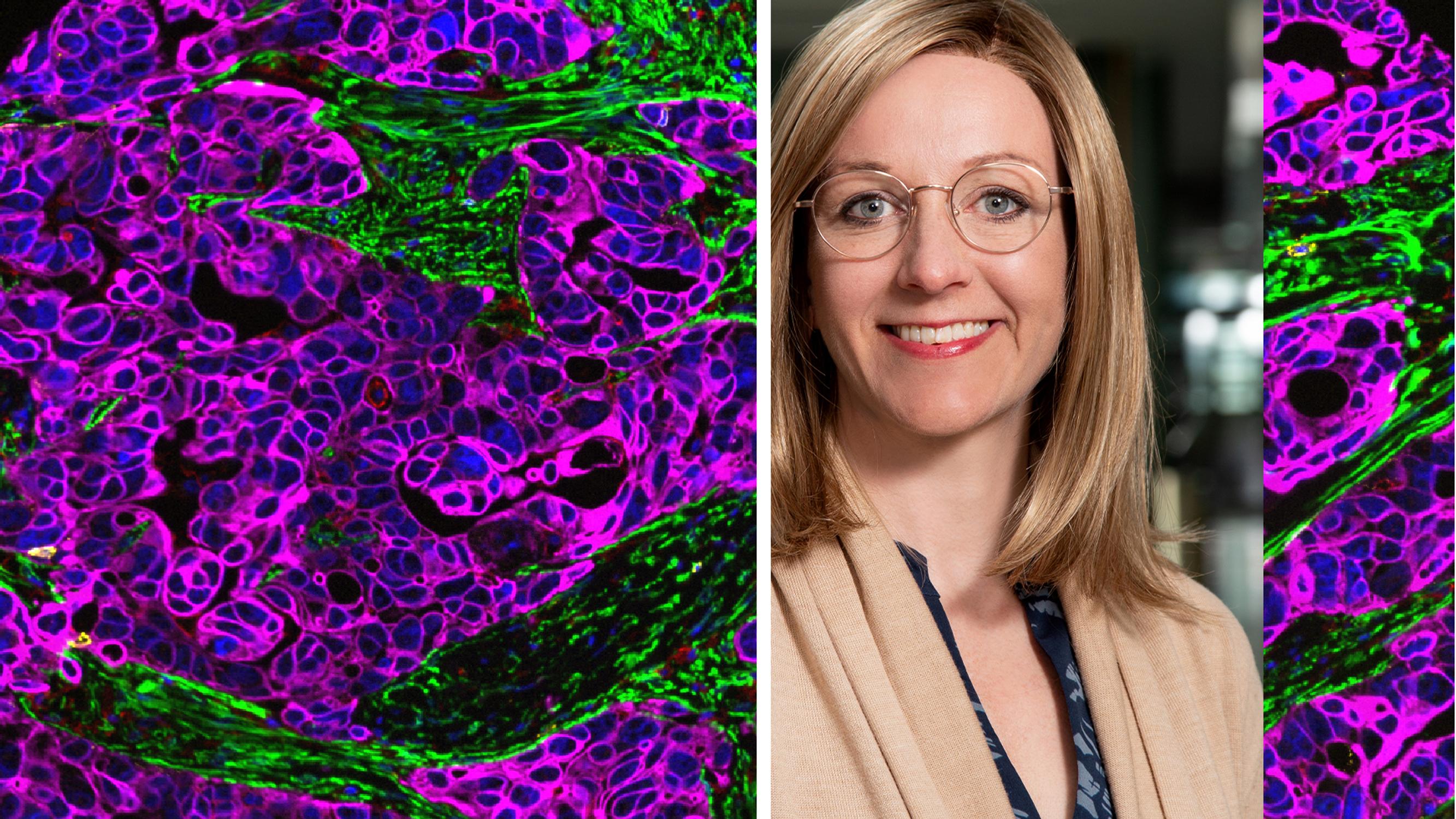 Suomalaiset tutkijat tekivät merkittävän löydön: syöpä piiloutuu ja muokkaa elimistön puolustusta – Tieto voi mullistaa munasarjasyövän hoidon