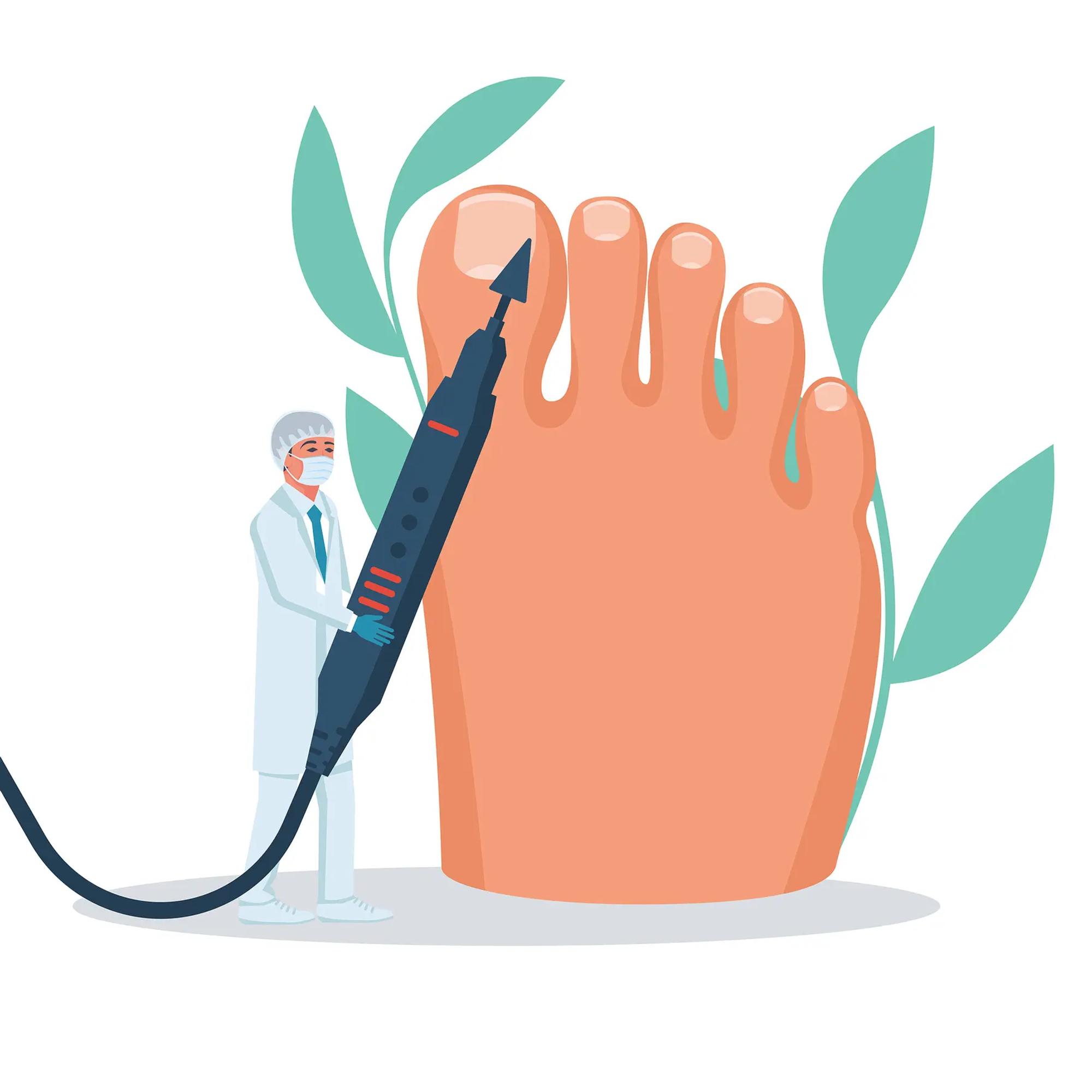 Paksuuntuneet varpaankynnet repivät sukat rikki – Kynsisienen hoito ei auttanut – Lääkäri neuvoo, mitä tehdä