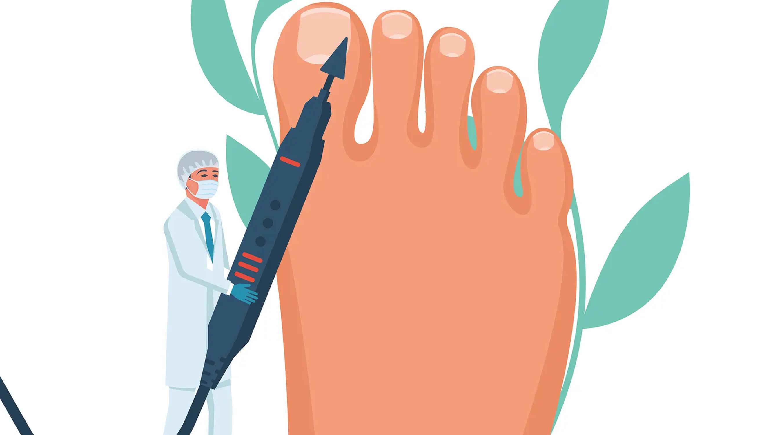 Paksuuntuneet varpaankynnet repivät sukat rikki – Kynsisienen hoito ei auttanut – Lääkäri neuvoo, mitä tehdä