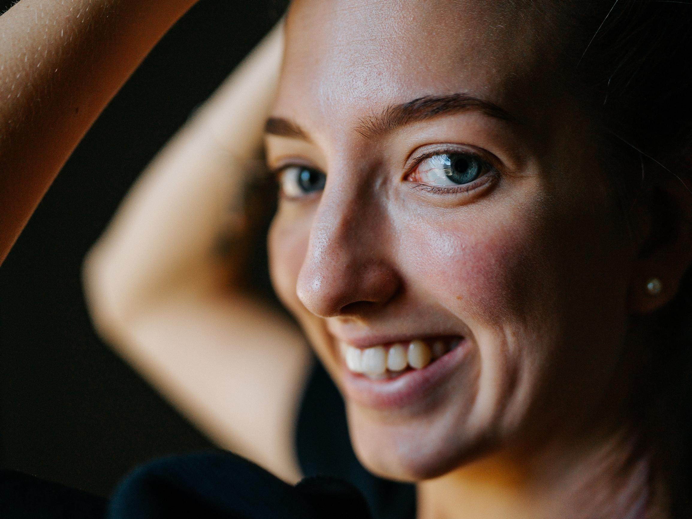 Petolahtelaisen Traceyn syntymämerkkiä poistettiin 22 vuotta – ”Ulkonevat laajentimet solisluiden ihon alla näyttivät rinnoilta, ja siitähän sain kuulla”