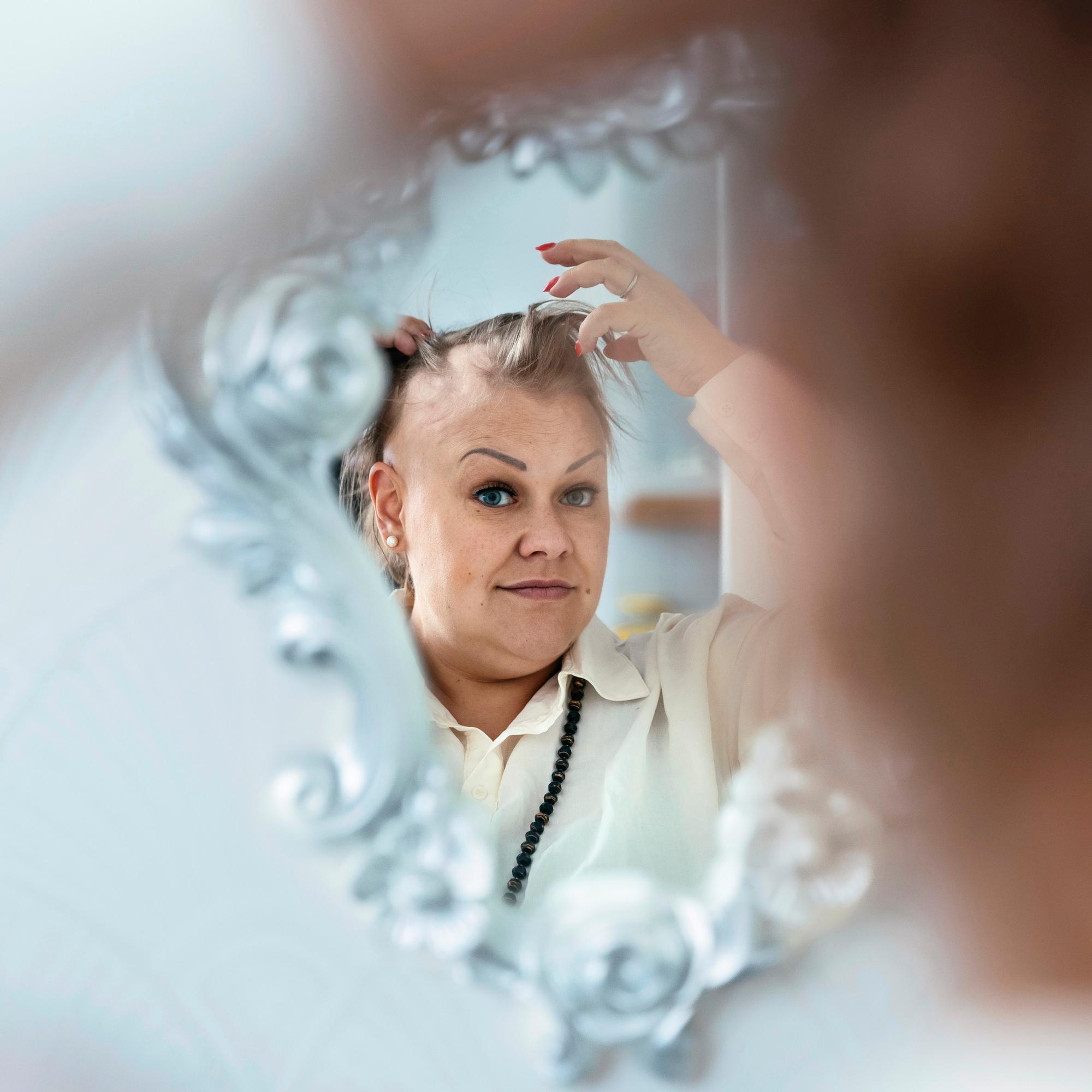 Ensin käteen jäi tuppo tukkaa – Alopecia vei Linda Leinoselta hiukset, ripset ja kulmakarvat muutamassa kuukaudessa – ja murensi itsetunnon