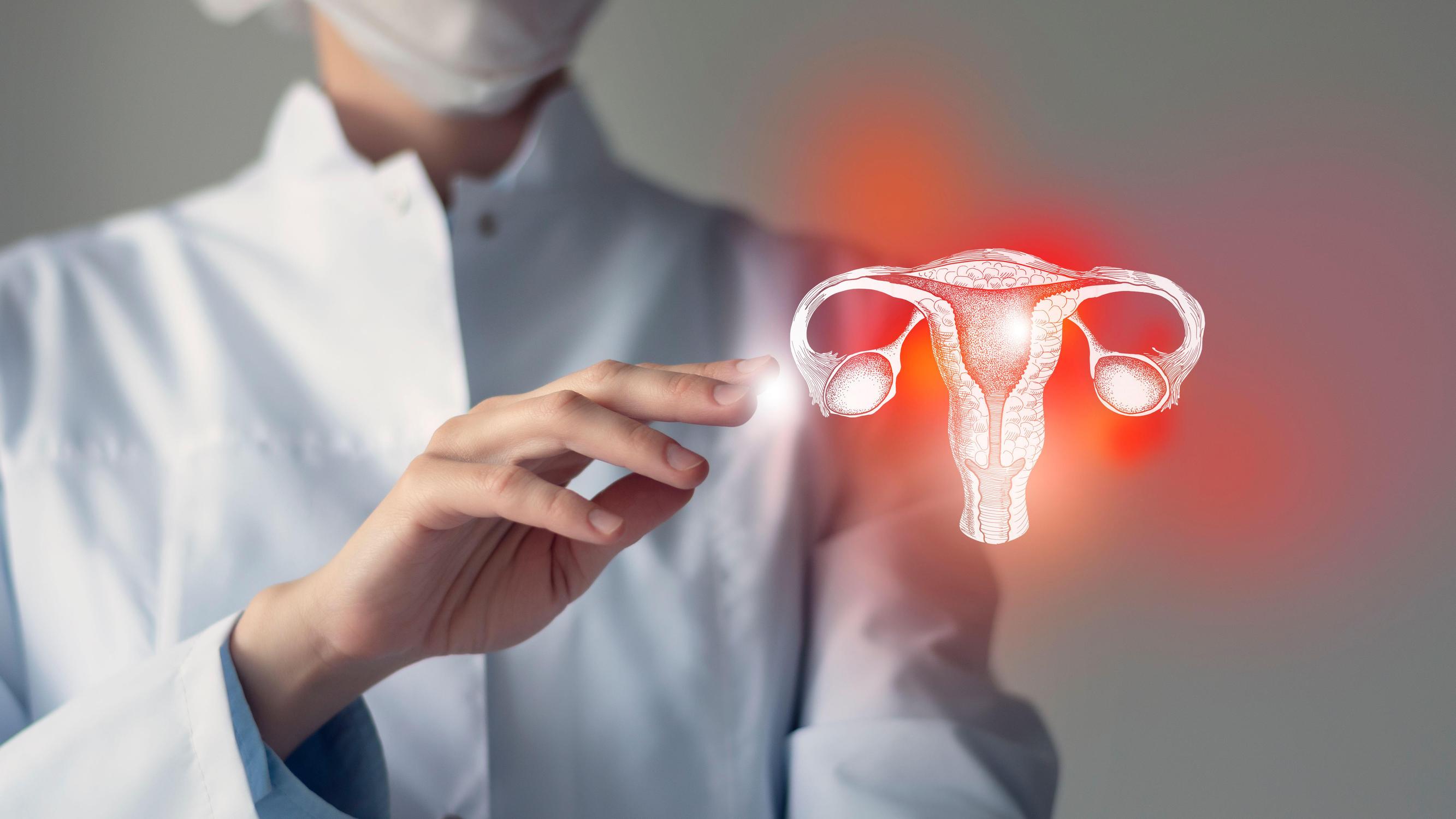 Kohdunkaulan syövän esiasteista joka viides jää löytämättä seulonnassa – HPV-rokotteiden kattavuus riittämätön – Tästä on kyse