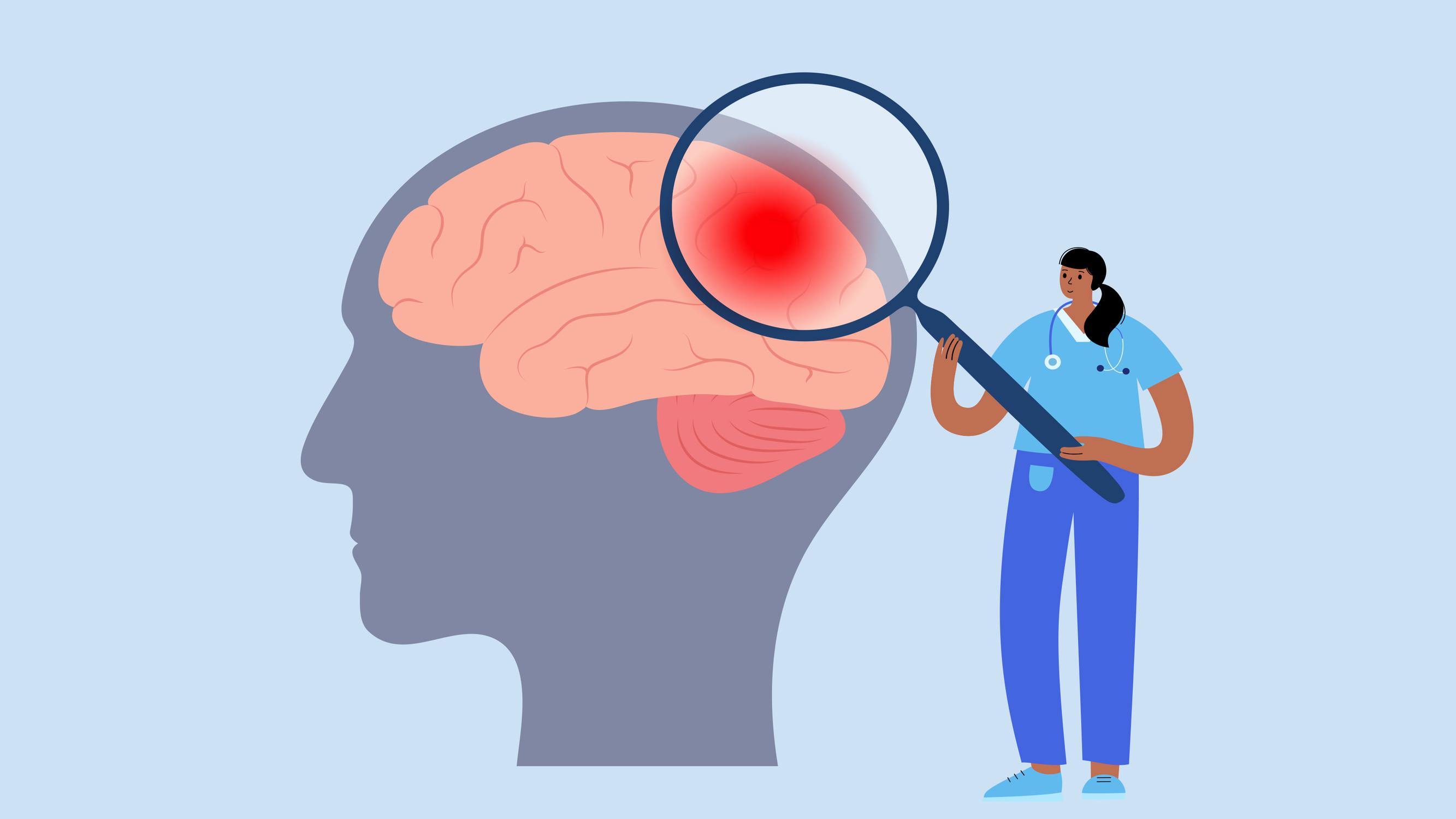 Aivoverenvuoto selvisin ilman oireita, kuinka helposti se uusii? Apu