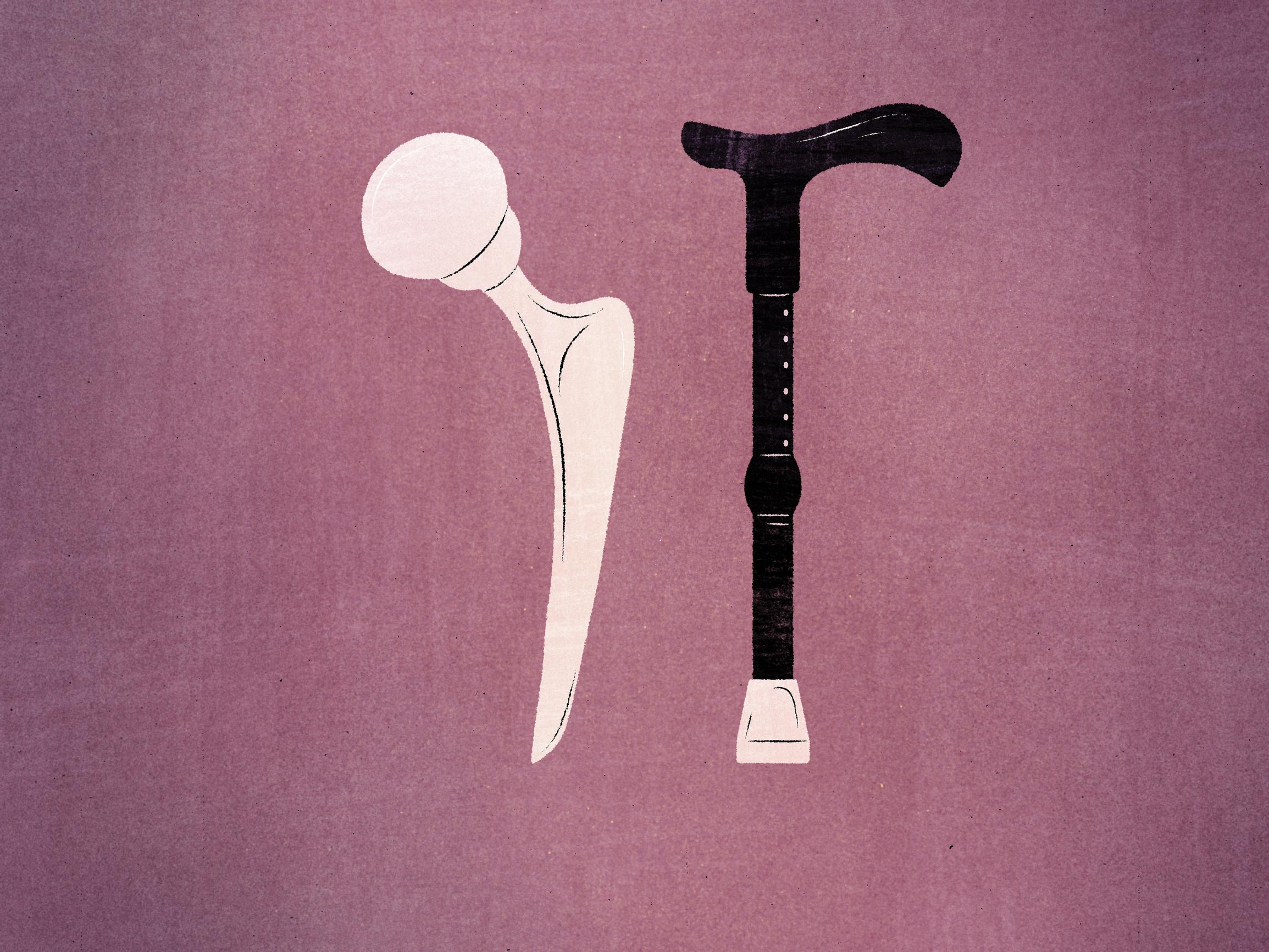 Tekonivelleikkausten määrät kasvussa – Selvitimme, miten sairaalat suoriutuvat tehtävästä