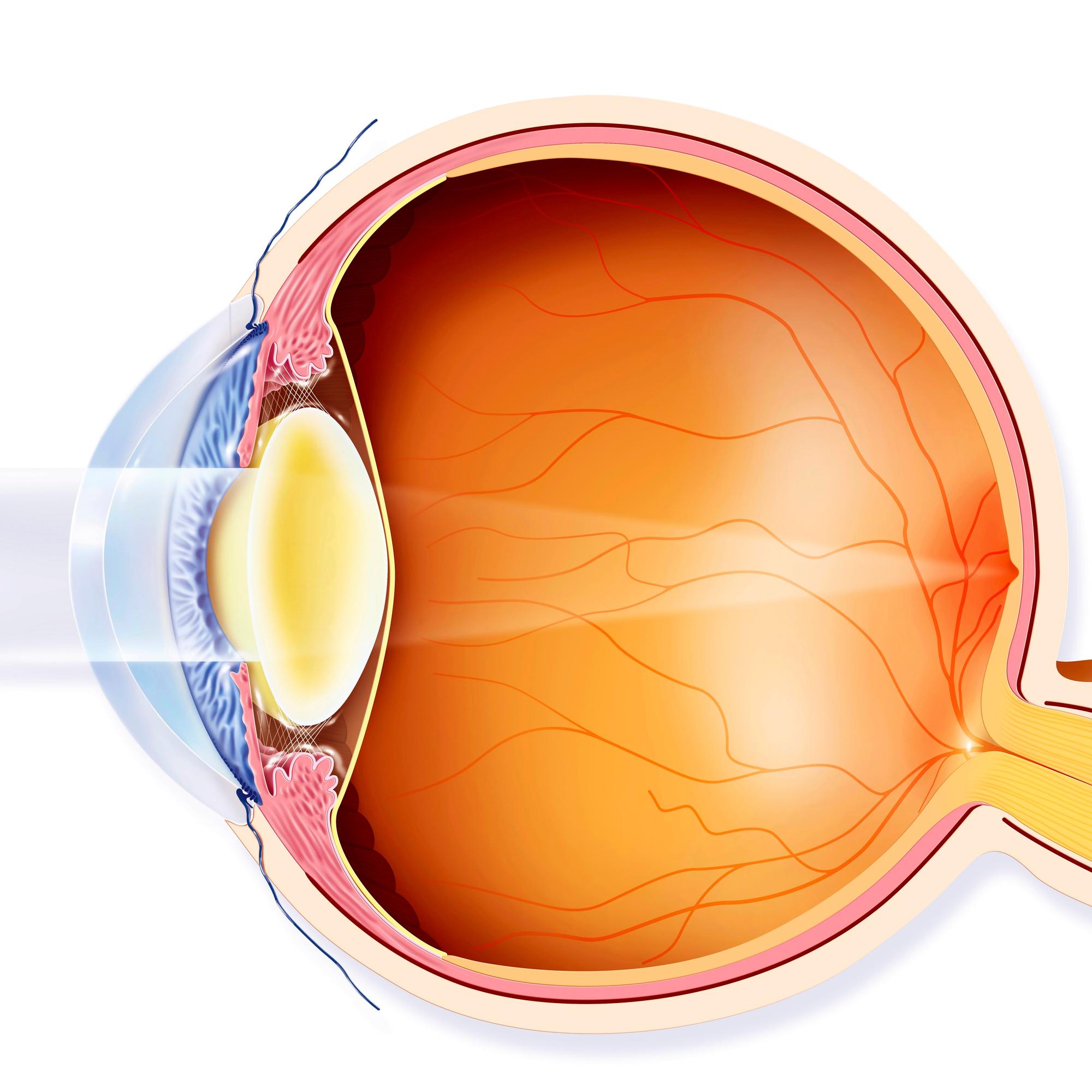 Kaihileikkauksen jälkeen voi tulla yllätyksiä – Tiina sai leikkauksen jälkeen verkkokalvon repeämän