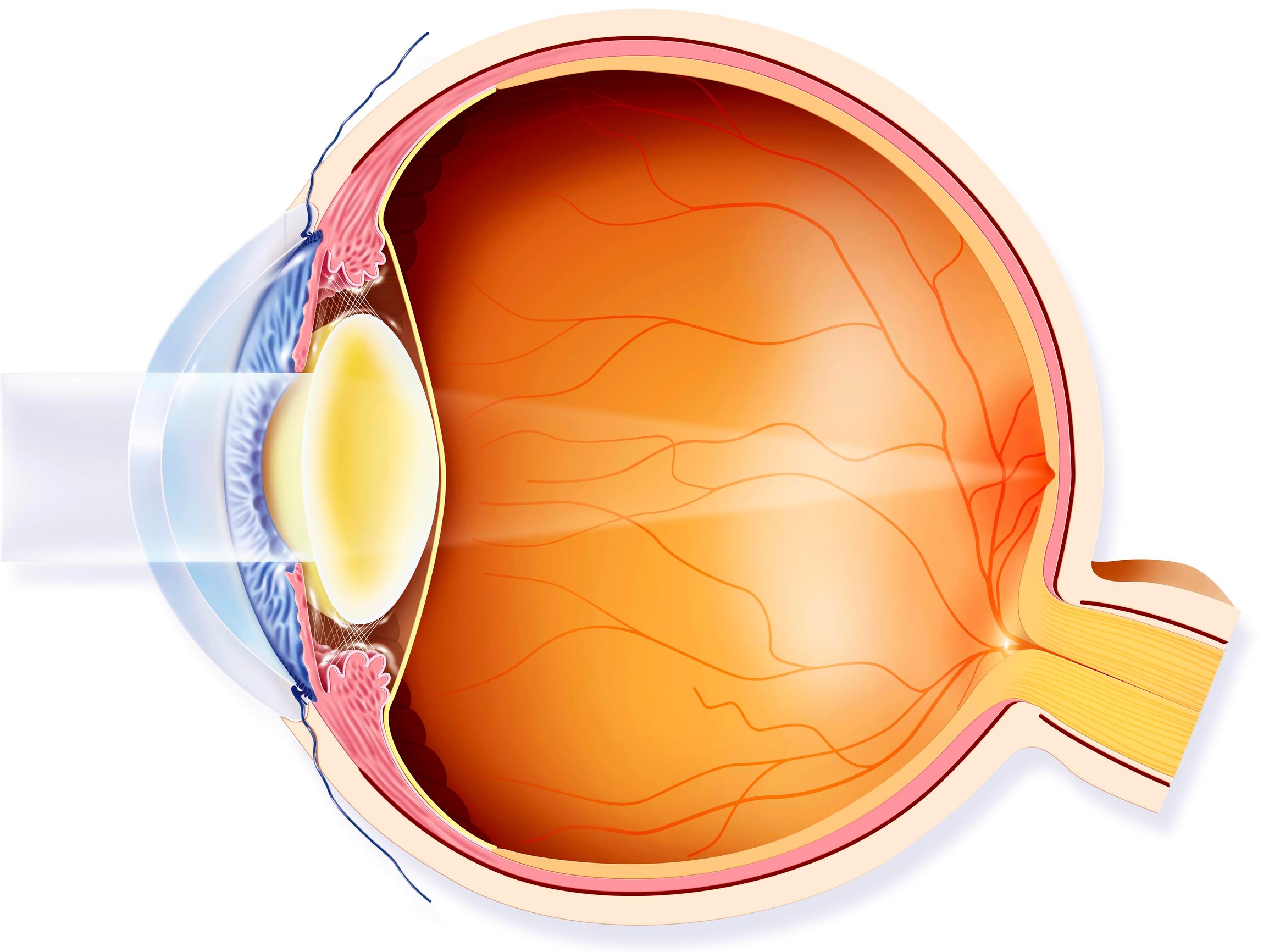 Kaihileikkauksen jälkeen voi tulla yllätyksiä – Tiina sai leikkauksen jälkeen verkkokalvon repeämän